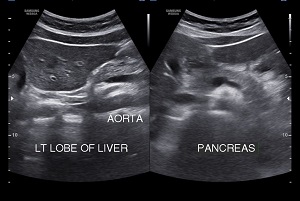 abdominal sonogram