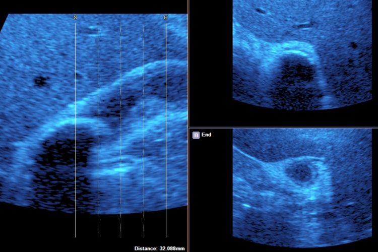 Gallbladder Calculus Disease | Sono Scan 5D