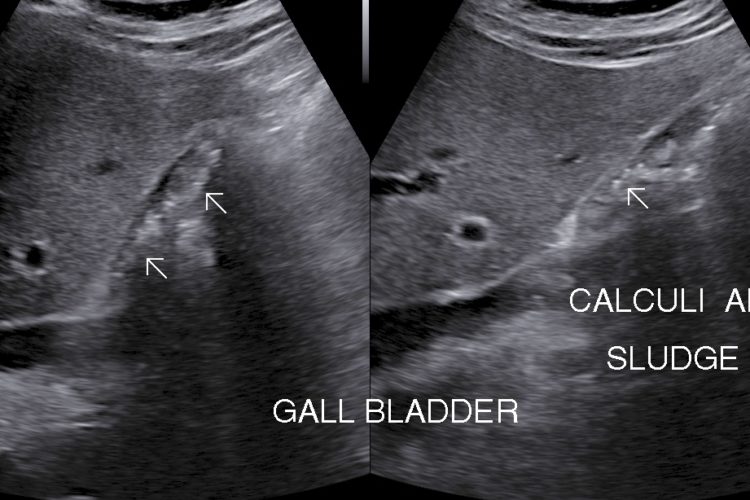 Gallbladder Calculus Disease | Sono Scan 5D